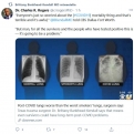 Egy egészséges, egy dohányos és egy koronavírusos tüdőröntgen képe. Dr Brittany Bankhead-Kendall twittere.